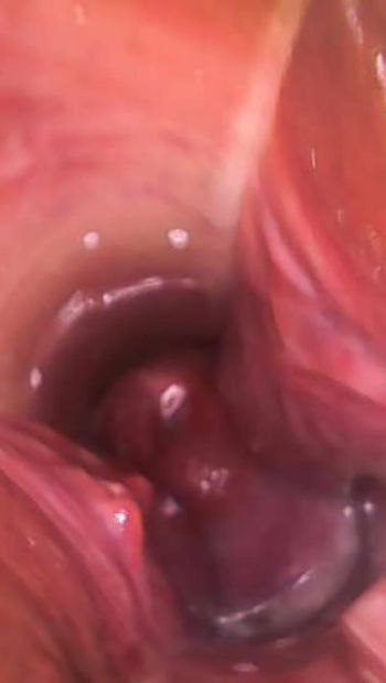 Exame do endoscópio da minha buceta e colo do útero