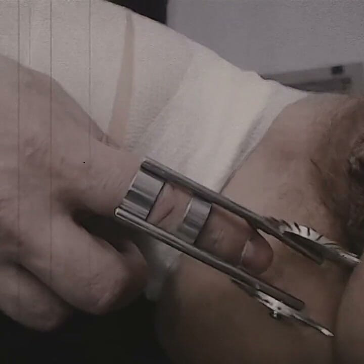 Full Bandage Mummification. Brown Noise. Wartenberg Protocol
