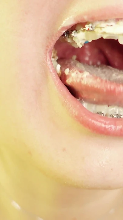 Key moment from "eating in braces - vore and food fetish - close up video"