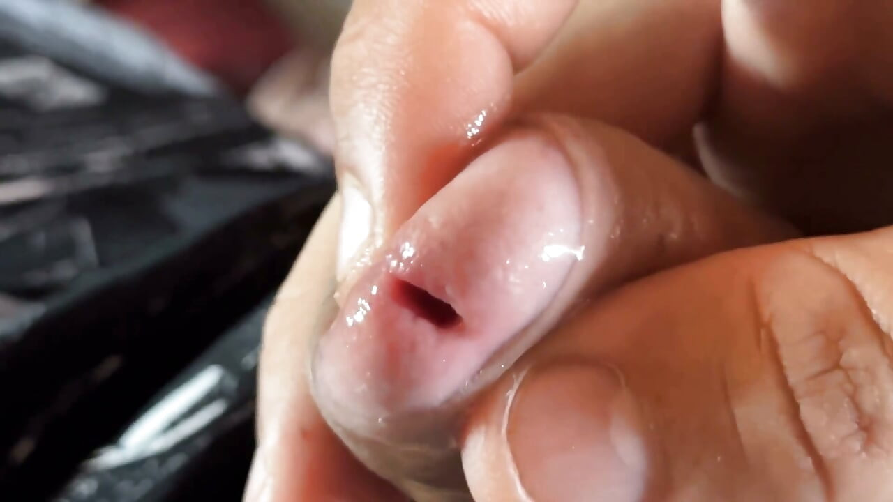 Extreme Detachment of Phimosis with Natural Oil