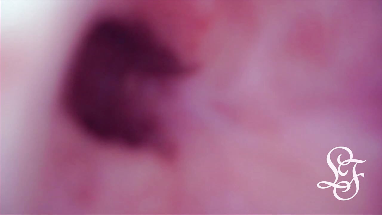 膀胱内突起 アナルから