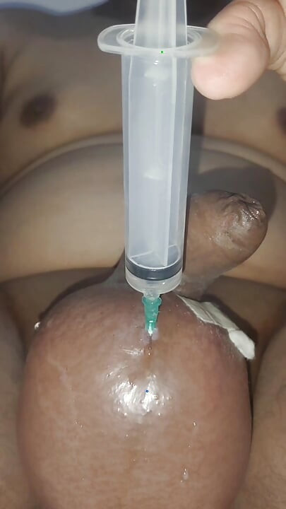 2 litre saline injection