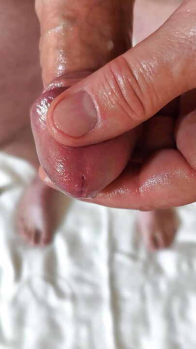 Foreskin back