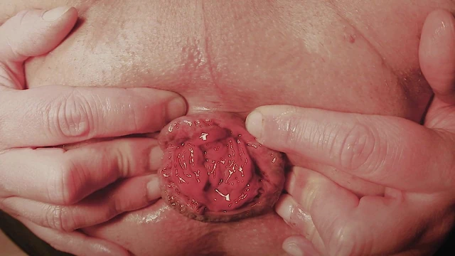 Anal Prolapse Beginners Training