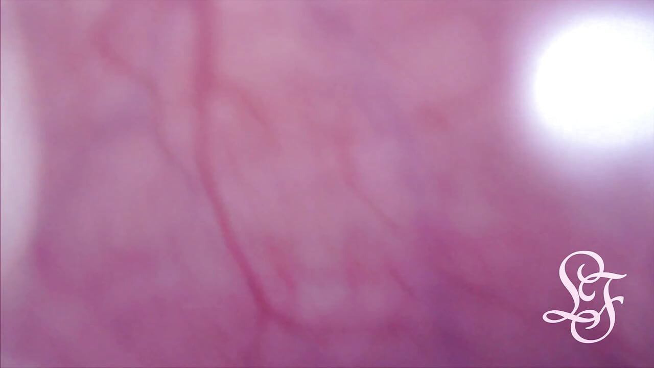 Bulge INSIDE my Bladder from Anal