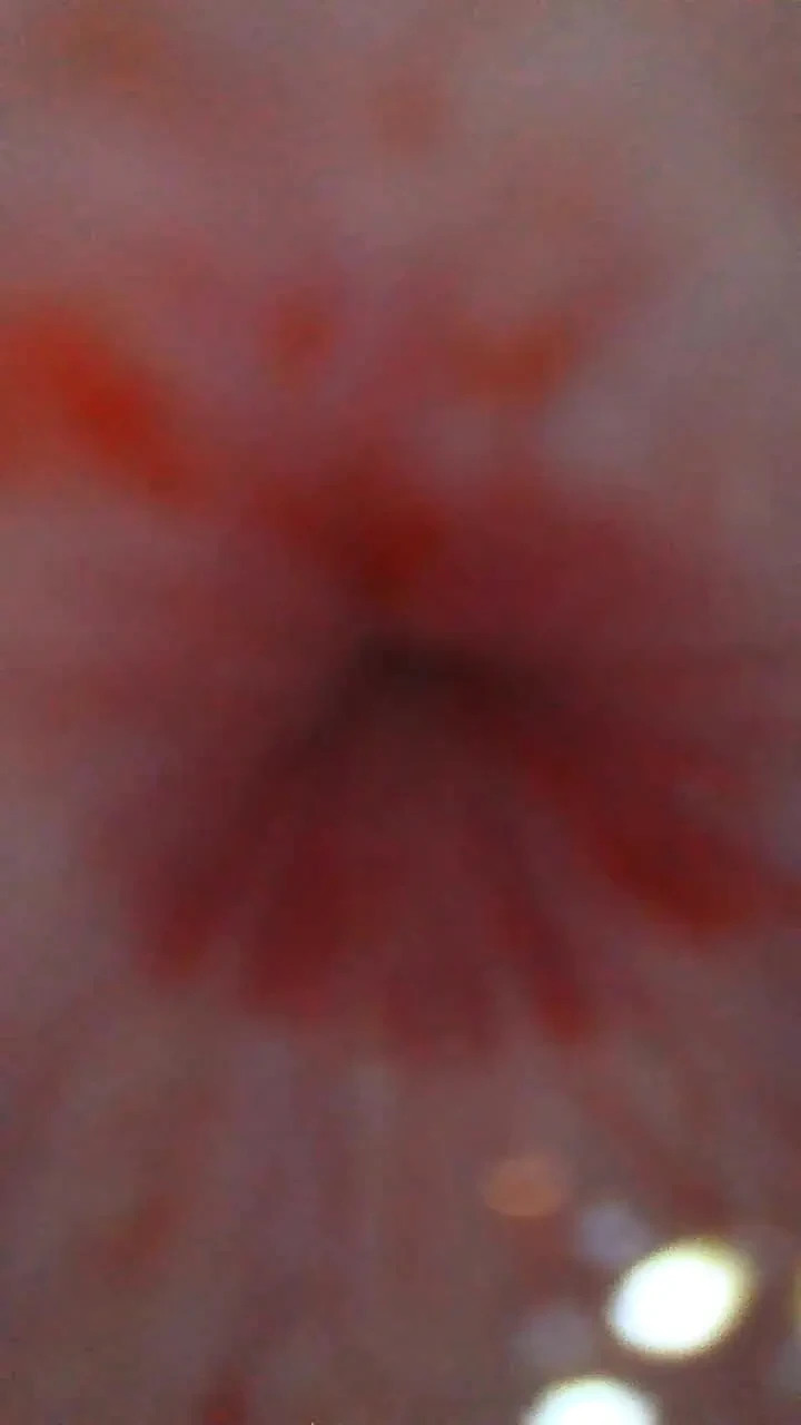 Endoscope from urethral opening to bladder