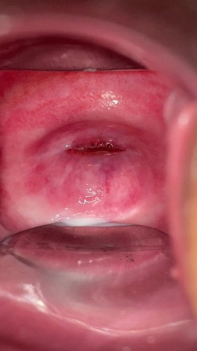 cervix