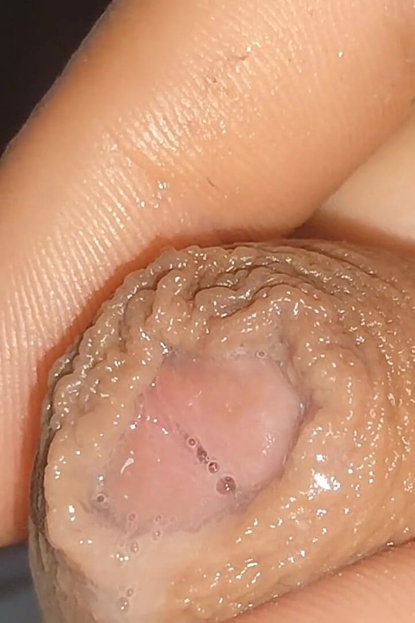 Curious Close-up of Pre-cum in Flaccid Phimosis.