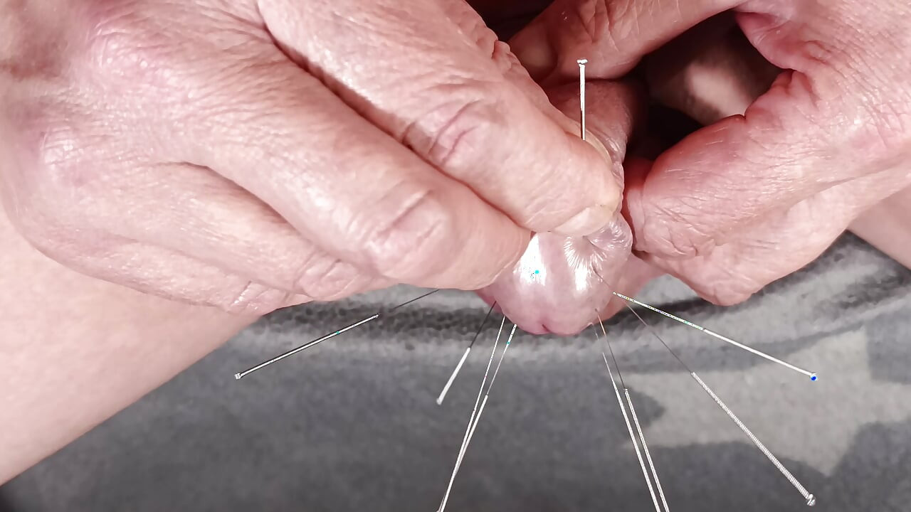 Double Pointed Needles, CBT, 10 Acupuncture Needles, Electric Dilator