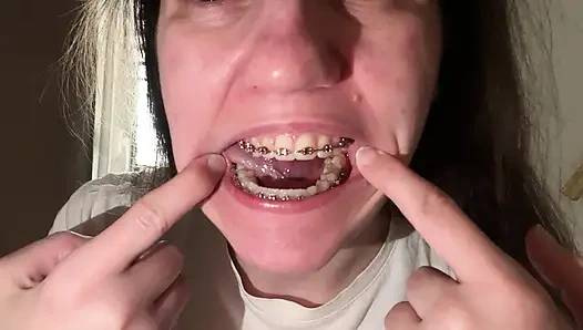 Mit der Zunge die Zahnspangen lecken