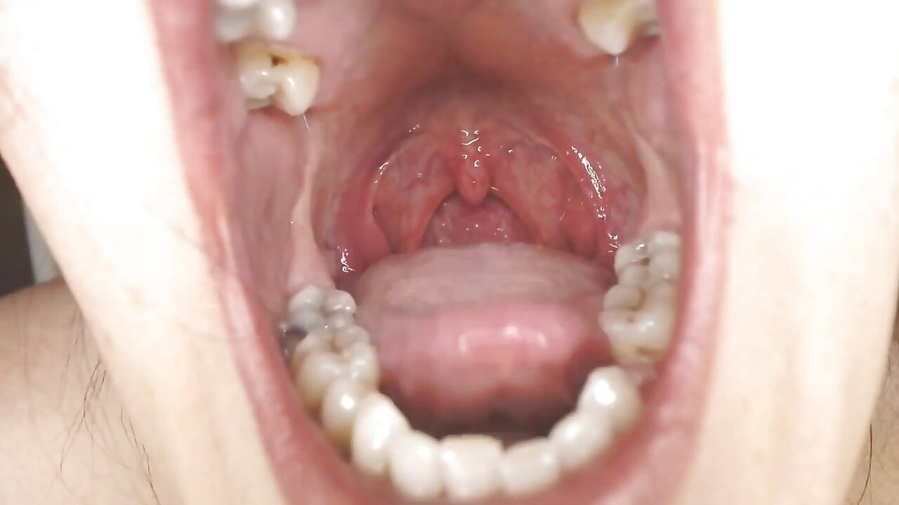 torok és száj köpködő húrok uvula mandulák uvula