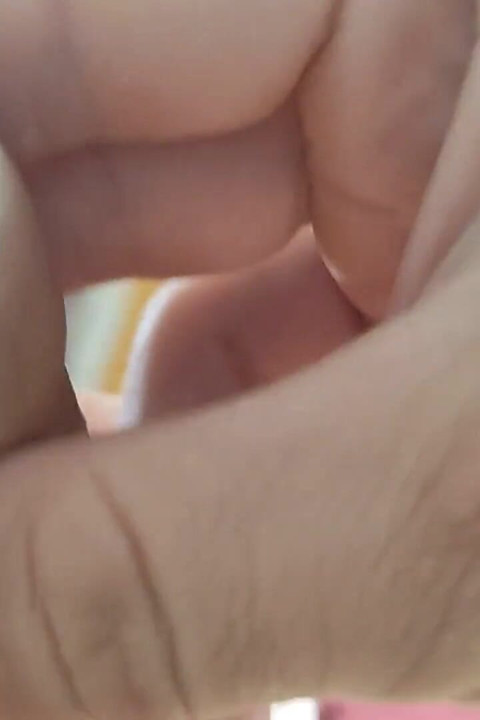 The Glans Appears Crowning Inside the Phimosis.