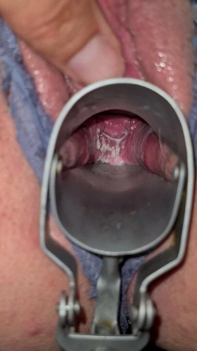Milky Cervix