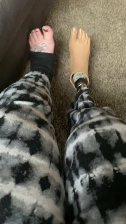 SAK AMPUTEE WITH PROSTHTIC LEG