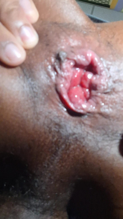 Start prolapse training Indian Boy