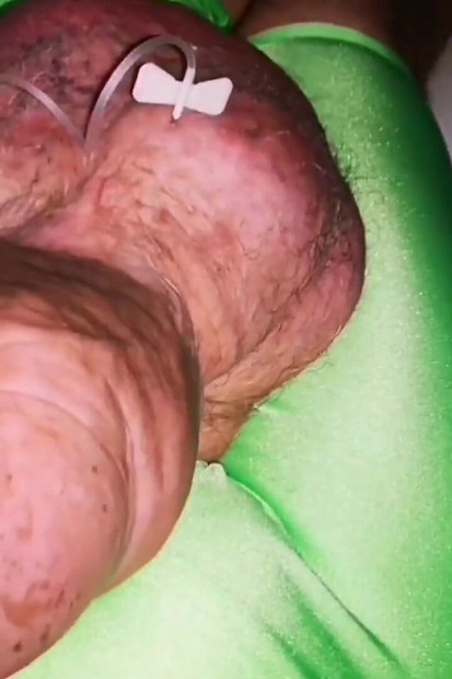 Another Extreme Filling up with Glucose