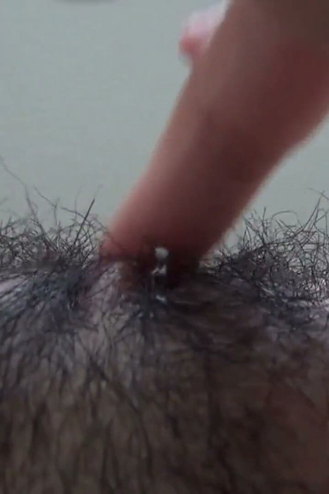 The Mound of the Clitoris