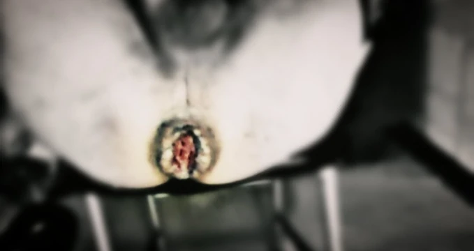 Anal destroy