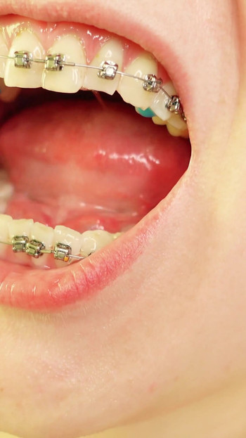 Powerful moment from "braces mouth tour video - vore fetish"