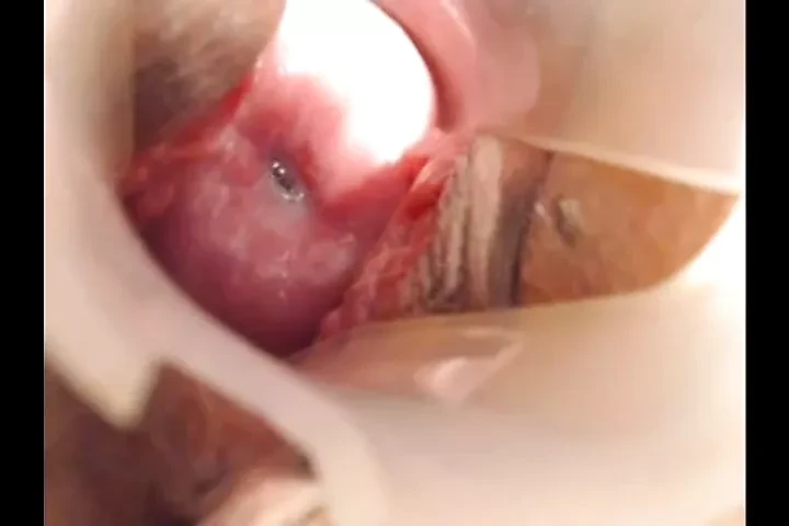 Long cervix show, speculum and try to insert pencil
