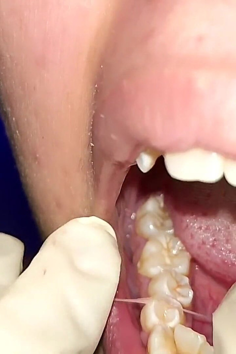 치실 사용해 보기 (클로즈업)