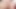 grandma prolapse her massive cervix