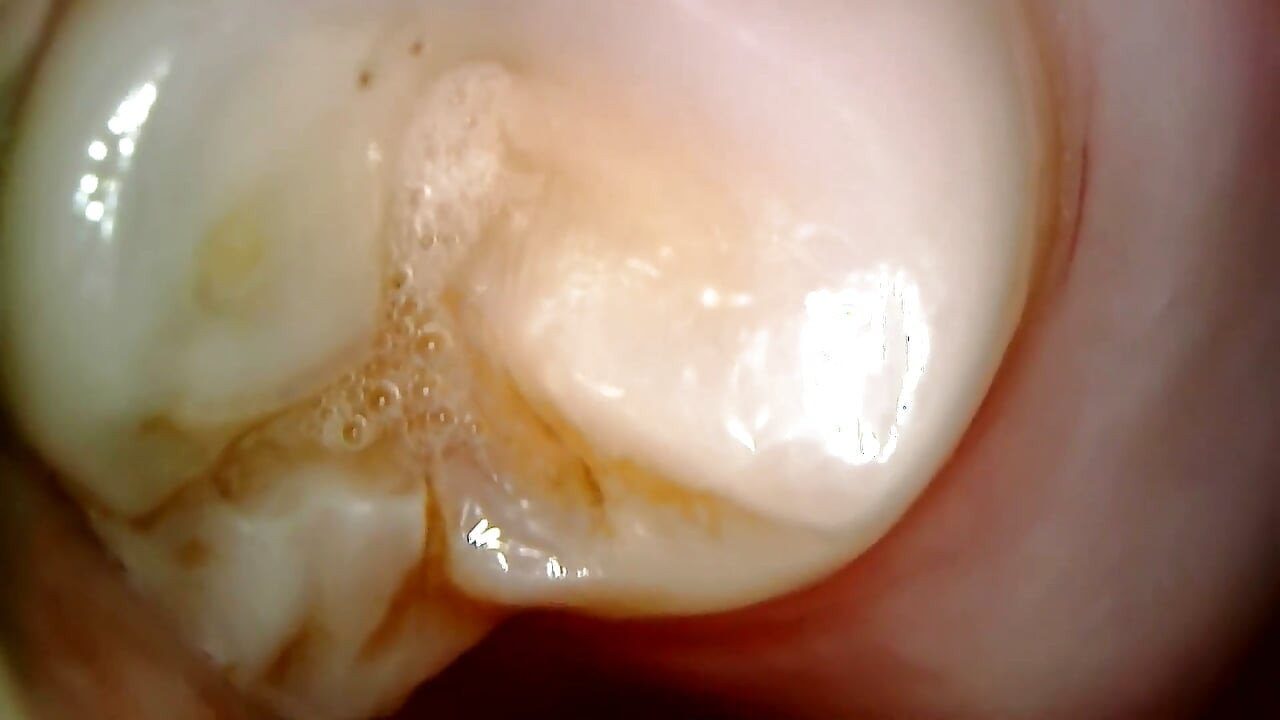 Kiểm tra miệng nội soi y tế: Nhai kẹo cao su, răng cực đoan & macro lưỡi