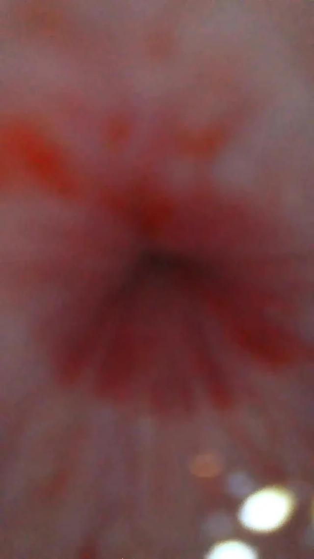 Endoscope from urethral opening to bladder