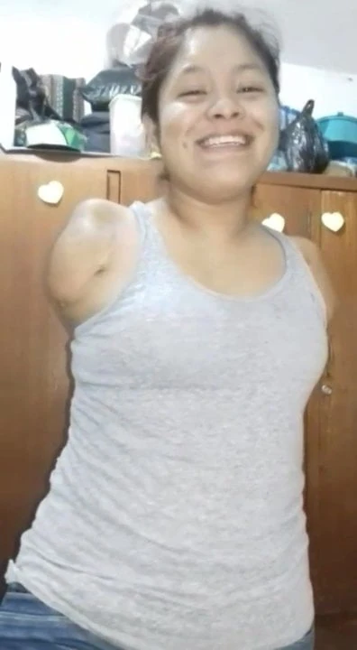 Amputee DSD girl