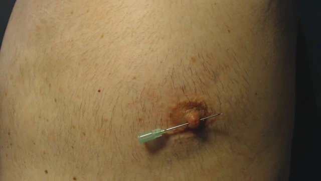 Nipple needle pain