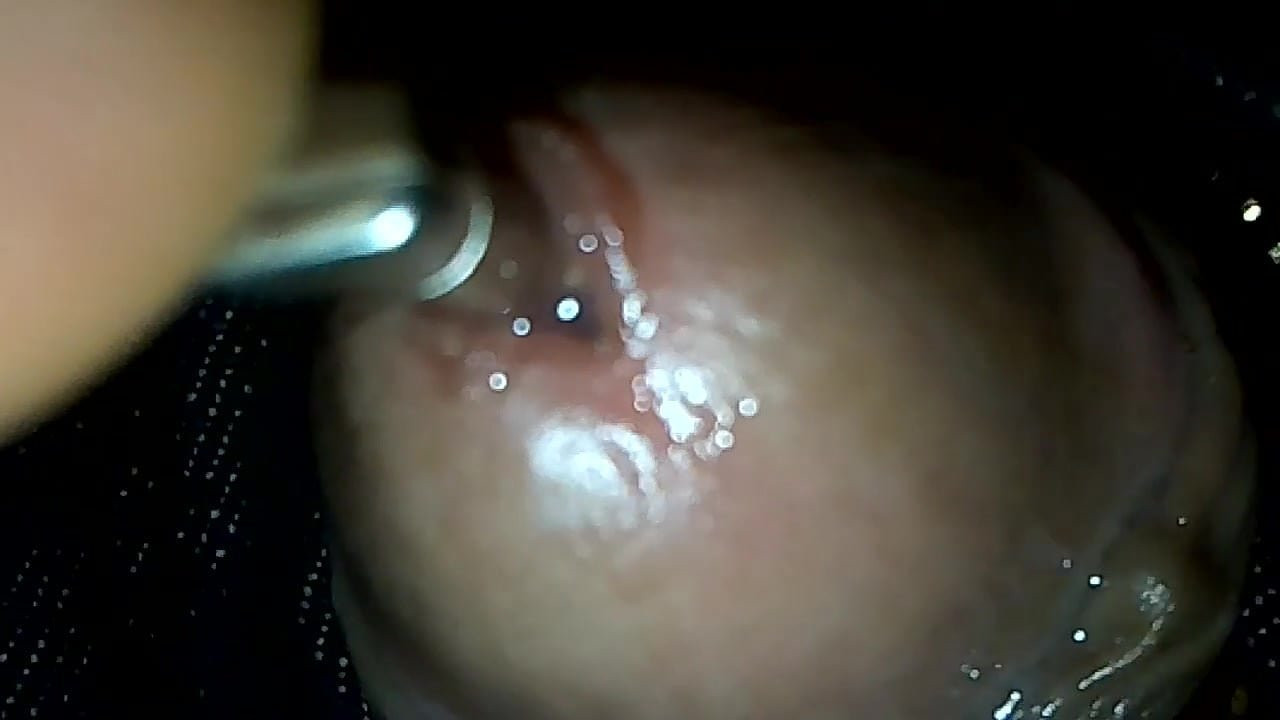 into urethra