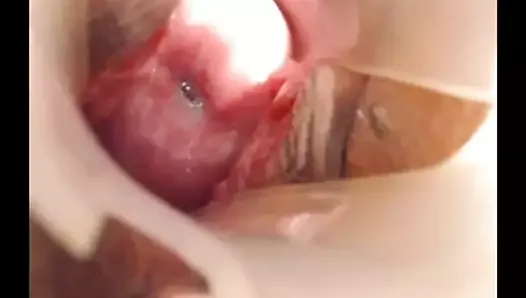 Long cervix show, speculum and try to insert pencil