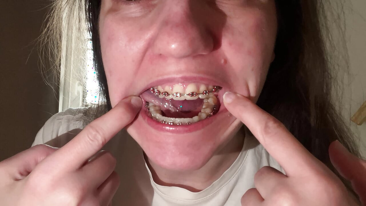 Licking Your Braces with Your Tongue