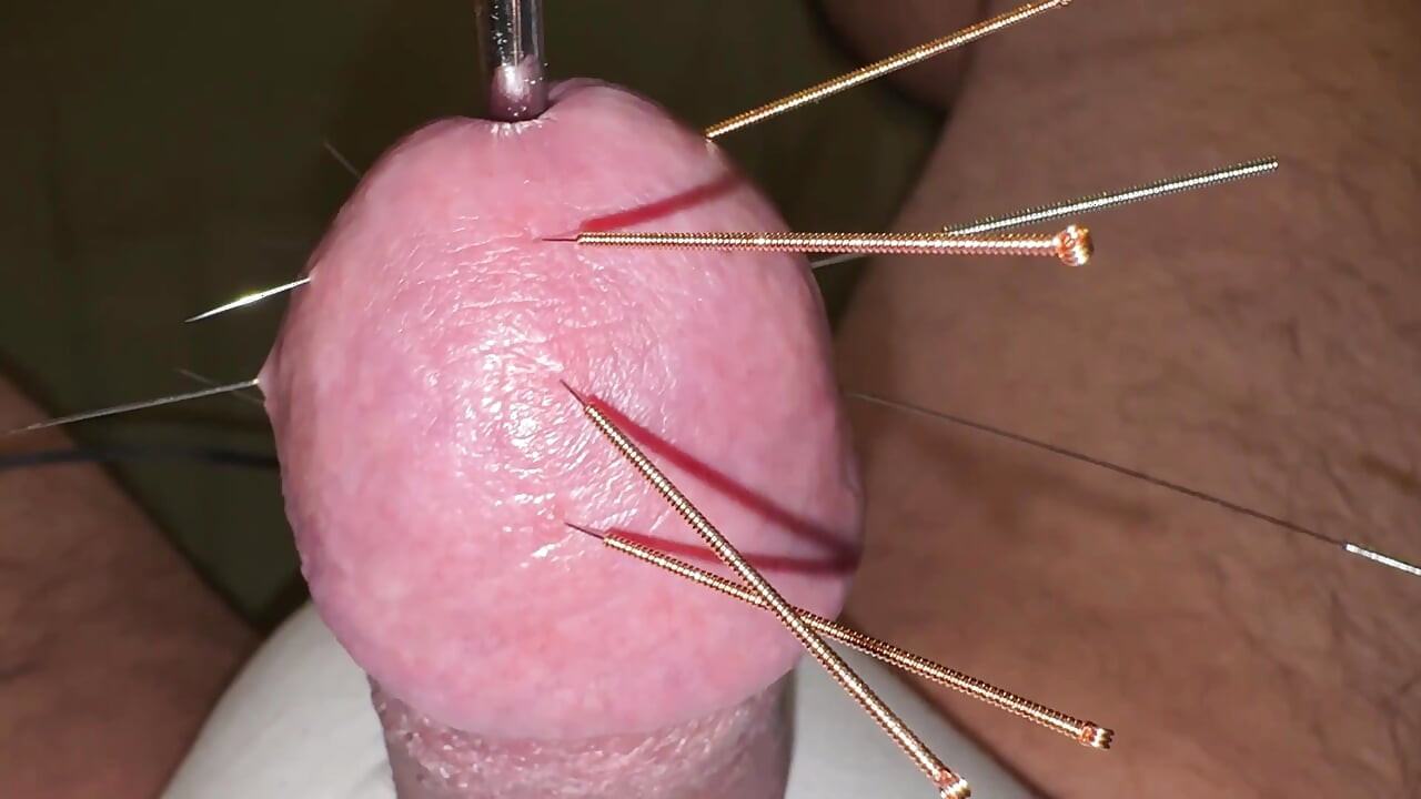 ¡acupuntura - ¡orgasmo!