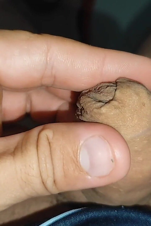 Inserting the Super Glue Through the Boy's Glans.