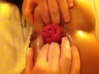 Anal Fisting and Prolapse