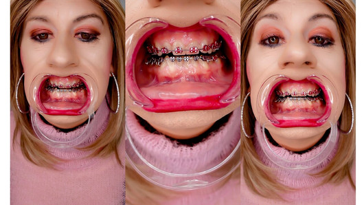 Braces fetish! See Alexandra Braces with an open mouth expander