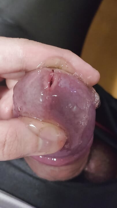 I injected gel made from my urine into my bladder