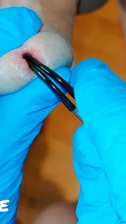 CFNM Nurse Part 3: Foreskin Stretching Treatment (Milking-time) | Clip 1