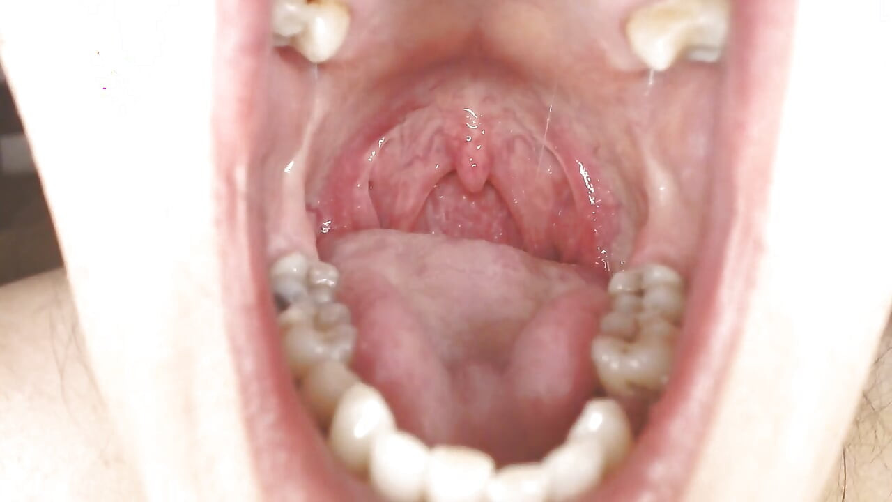 Глотка и рот слюнявы, строки Uvula, миндалины Uvula