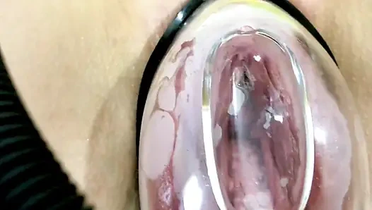 Deformasi Vagina Di Bawah Pengaruh Pompa Vakum