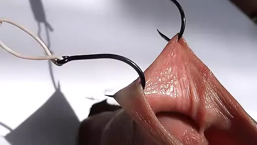 fishhooks in foreskin