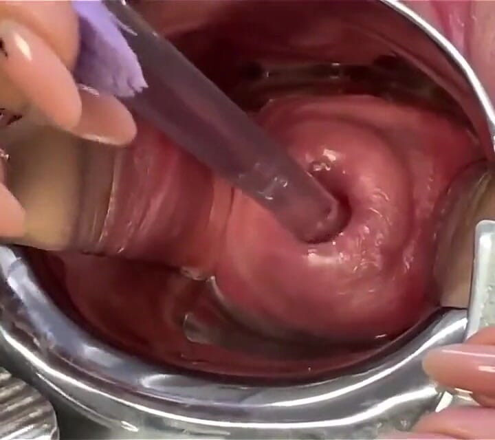Two Toothbrushes in Cervix