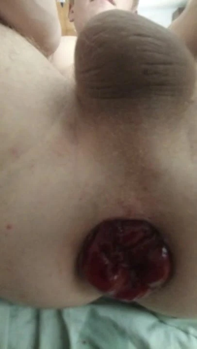 after one hour anal pumping my prolapse comes out