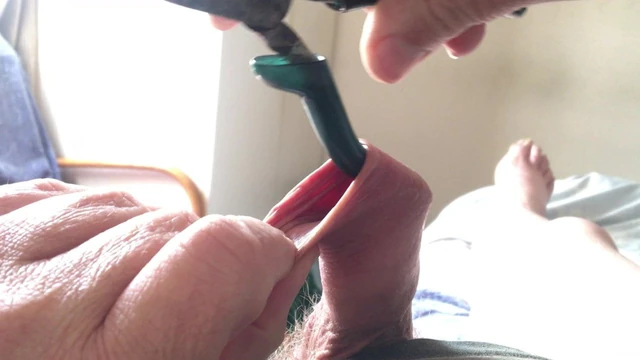 Foreskin with small blue pliers