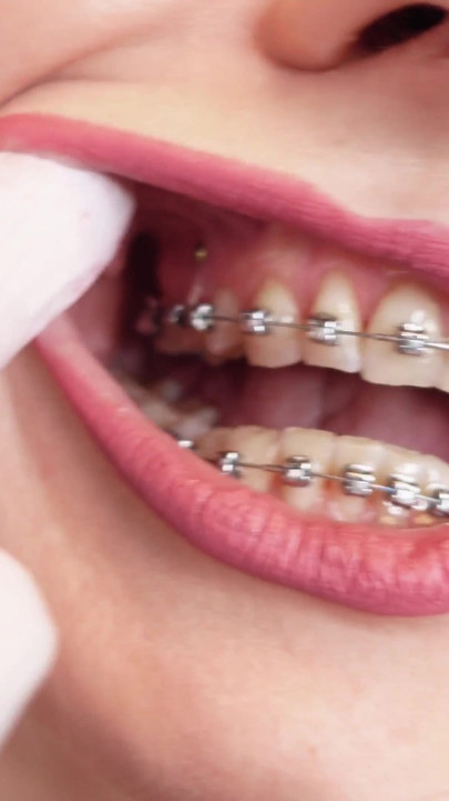 Must-see moment from "ASMR video: hot BRACES and double layer of medical nurse nitrile gloves (Arya Grander)"