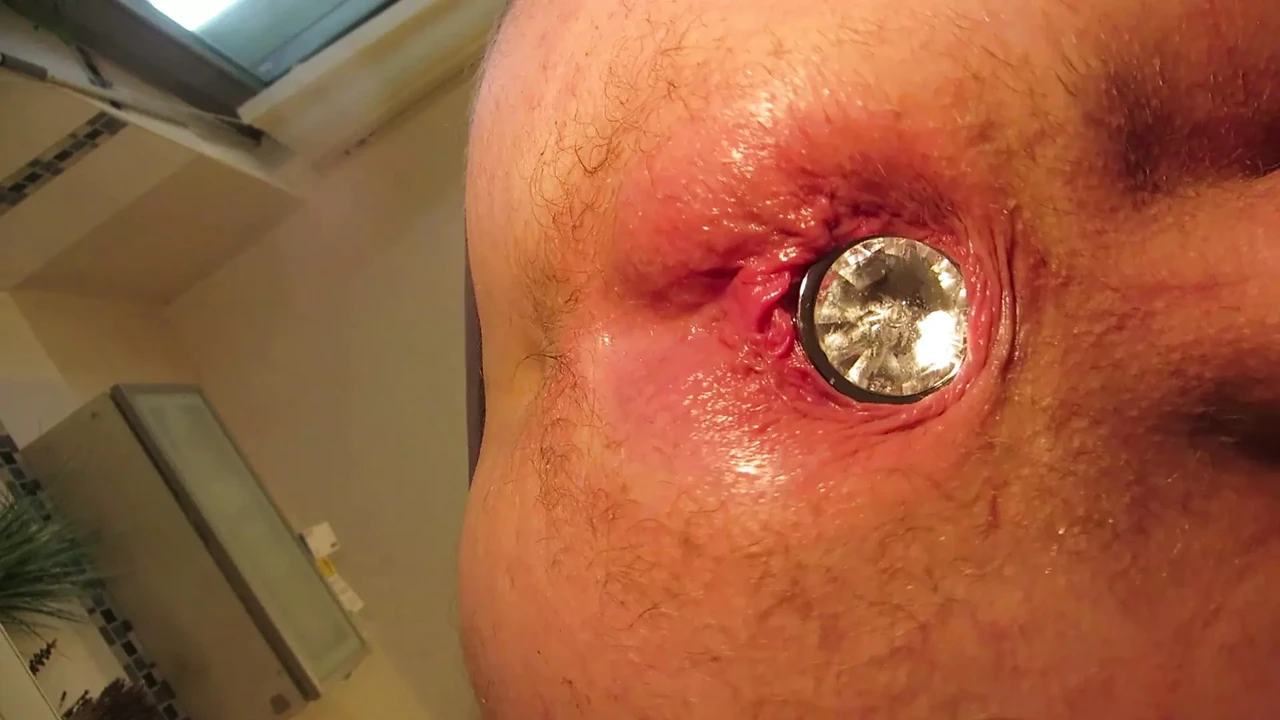 wifes and and husbands anal prolaps