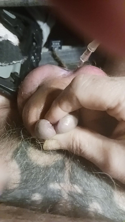Catheter Inflated