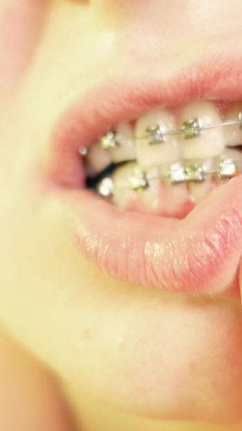 Iconic moment from "eating in braces - vore and food fetish - close up video"