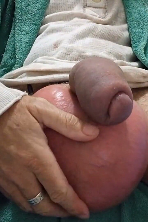 Saline - Before and After